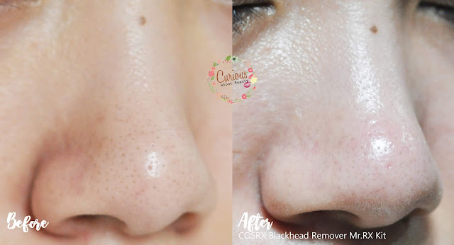 Before After COSRX Blackhead Remover Mr RX Kit