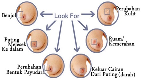 5 Penyebab Tumor Payudara yang Harus Kamu Ketahui