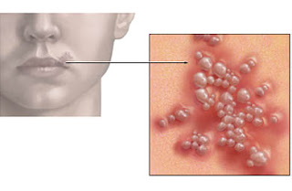 Cold Sore Or Pimple On Corner Of Lip : Adhatoda Vasica -vasa_ Best Herb For Respiratory Disorders