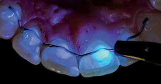 Low invasive fluorescence guided dentistry