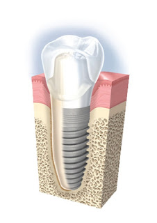 Cấy ghép Implant có tốt không?