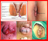 Obat Wasir Paling Ampuh Dari Tanaman Alami