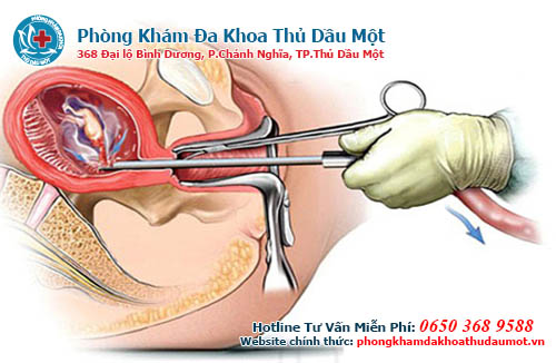 Nạo phá thai là gì