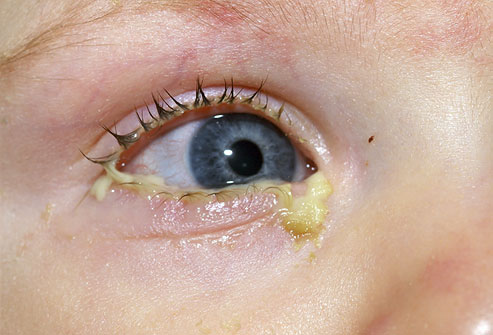  allergic pinkeye.When the drainage is more greenish-yellow(and there's a 