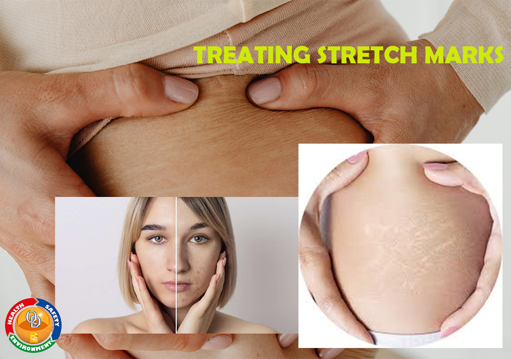 QHSE DOCUMENTS-TREATING STRETCH MARKS
