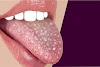 Canker Sore On The Tongue: Causes, Symptoms, and Remedies 2020