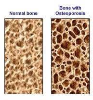 osteoporosis