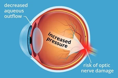 Primary open angle glaucoma treatment options