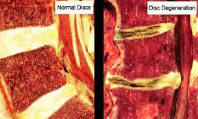 Degenerative Disc Disease