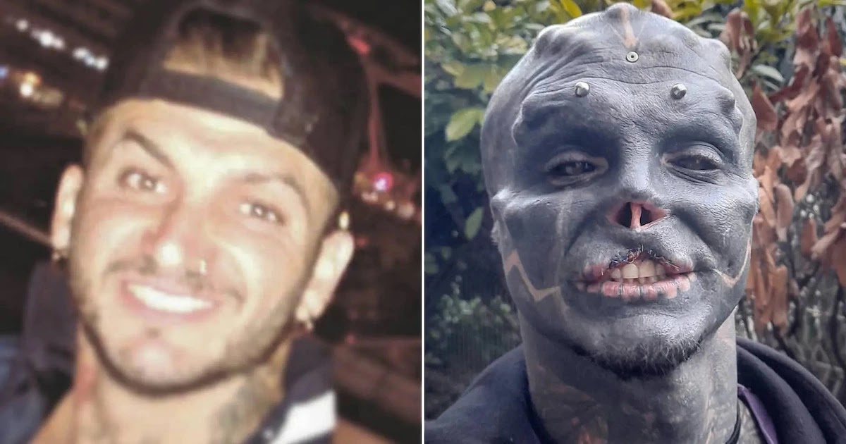 Man Who Wants To Turn Into A 'Black Alien' Has His Nose And Upper Lip Removed