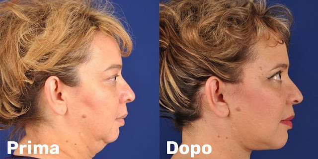 Lifting del viso e tratamento del viso di una donna di 61 anni, prima e dopo l'intervento