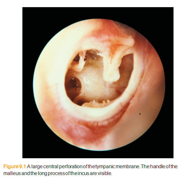 A large central perforation of the tympanic membrane