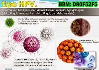 Obat Kutil Kelamin, Cara Mengobati Kutil Dikemaluan Kelamin Dari Rumah Sendiri, Dokter Obat Kutil Kelamin Terbukti Terbaik Dan Terpercaya