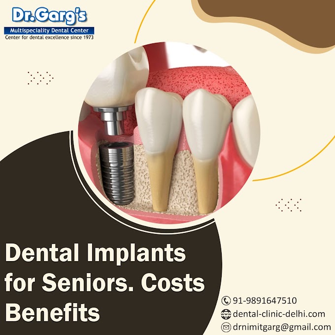 Dental Implants for Seniors. Costs | Benefits