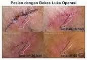 Obat Luka Bekas Operasi Caesar