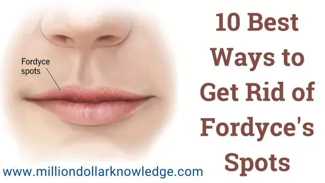 How To Get Rid Of Fordyce Spots