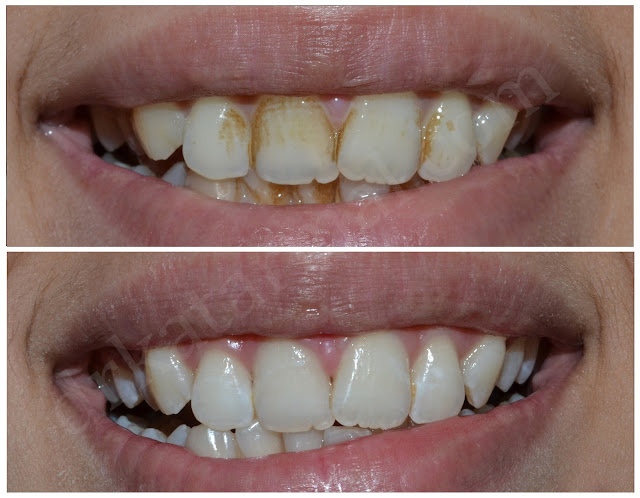 Teeth Cleaning with Ultrasonic Scaling at Jamnagar