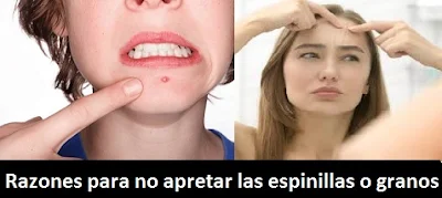 Razones para no apretar las espinillas