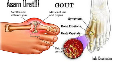 obat asam urat tradisional