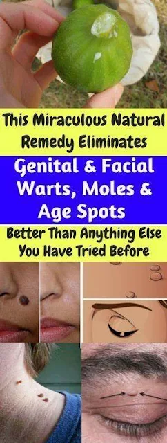 This Miraculous Natural Remedy Eliminates Genital And Facial Warts, Moles And Age Spots Better Than Anything Else You Have Tried Before!