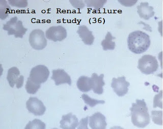 Case study (36) – Anemia of Renal Failure