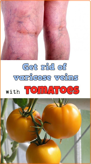 How To CureVaricose Vein With The Help Of Tomato