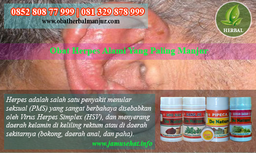 obat herpes bernanah