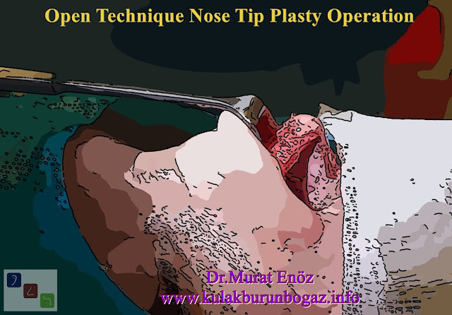 Nasal tip aesthetic surgery can be performed under local anesthesia, sedation anesthesia or general anesthesia. Nasal tip aesthetic surgery can be performed with two different approaches, open technique and closed technique. Since I generally prefer to fill the cartilage membrane, soft tissue and cartilages from the patient's own nasal tissue into the nasal tip of the patient; I prefer open technique nasal tip aesthetics more. Although both techniques have advantages and disadvantages compared to each other; The incision scar of the 5-cornered incision used in open technique surgery heals invisibly after approximately 3 weeks. Nasal tip surgeries can be performed together with deviation surgery for nasal congestion and concha surgery.