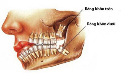 Răng khôn mọc khi nào? Mọc ở đâu