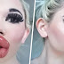  Cette femme qui rêve d’avoir les plus grosses lèvres du monde a subi une 20e injection