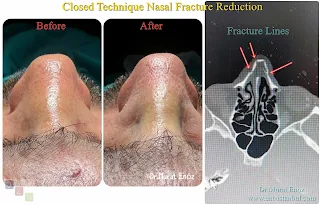 Closed Technique Nasal Fracture Reduction Photos - Before and After