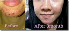 24_Jeunesse-Acne is small matter in Luminesce[4]