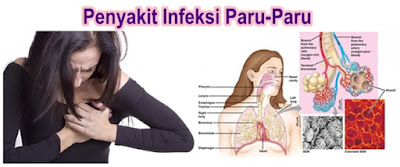 RESEP OBAT INFEKSI PARU PARU DI APOTIK