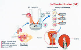 IVF Procedure 