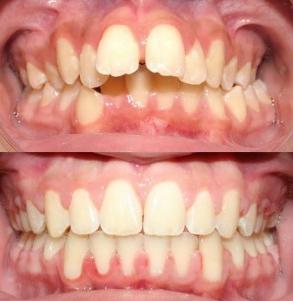 Phương pháp điều trị răng hô nhanh chóng hiệu quả