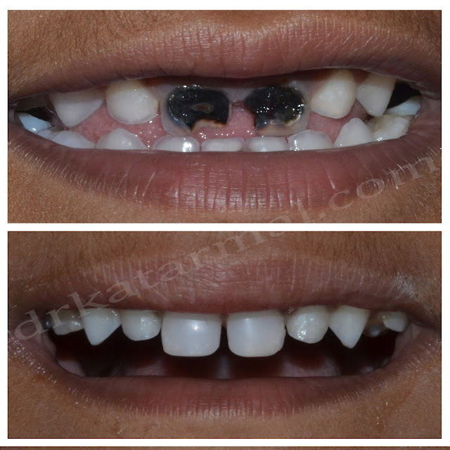 Carious Milk Teeth Treated with Cosmetic Composite Filling