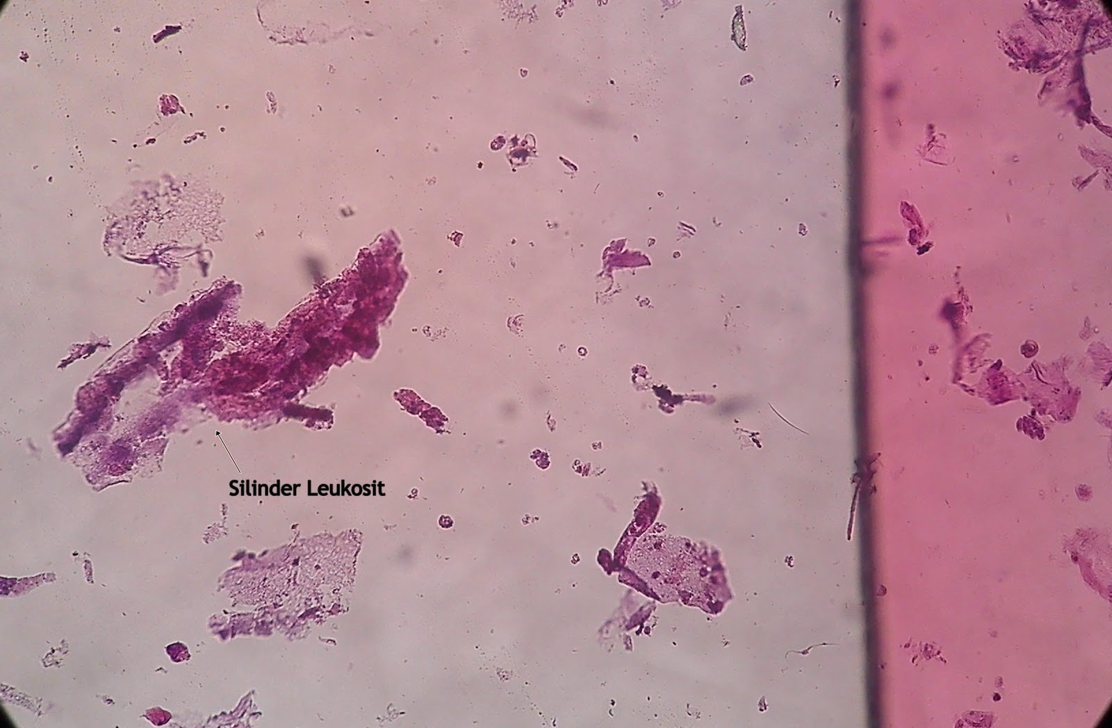 Sedimen Urine Metode Pewarnaan Stainning Analis Kesehatan