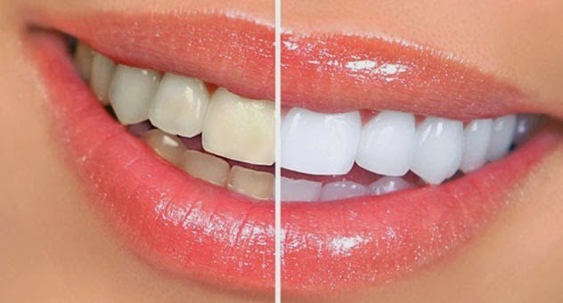  Cara Alami Membersihkan Karang Gigi Dengan Cepat dan Mudah
