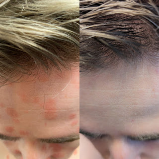 Two forehead comparison pictures of a male from showing one year of psoriasis improvements, the right displaying total skin healing.