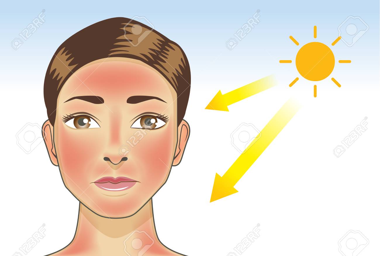 How can you deal with sunburn on the face?