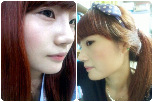짱이뻐! - Got My Cleopatra Nose At Wonjin Plastic Surgery Clinic Seoul Korea