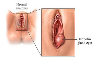Cara Mengobati Kista Bartholin Secara Alami