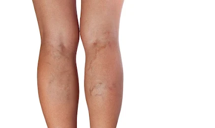 What to Avoid With Varicose Veins