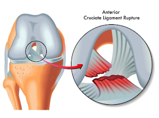 What is ACL? How you get Injured?