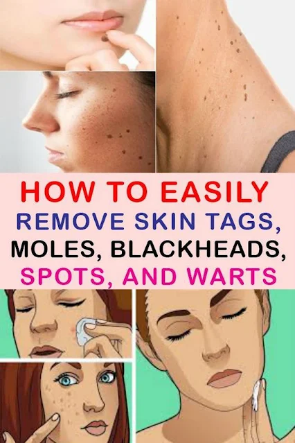 Natural Remedies for Common Skin Problems (Warts, Dark Spots, Blackheads, Skin tags)