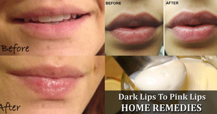 inflamed lips home remedy