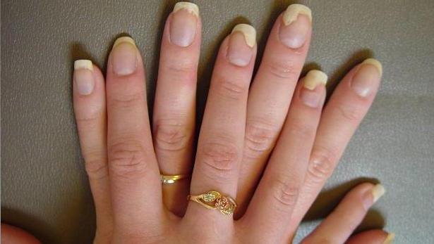 Paronychia Finger Nail Infection Home Tips I How Do