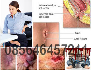 Cara Menyembuhkan Penyakit Wasir Akut Laki-Laki