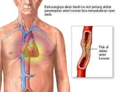 Stable Angina