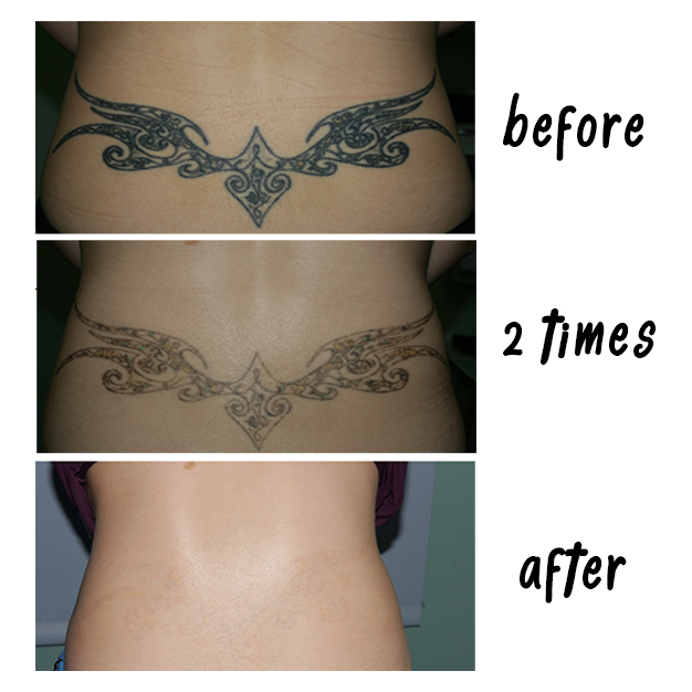 Tattoo Removal after 7 Q-switch ND Yag treatments , These picture ...